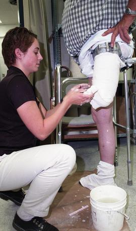 Woman creating cast of residual limb [4 of 4 photographs]